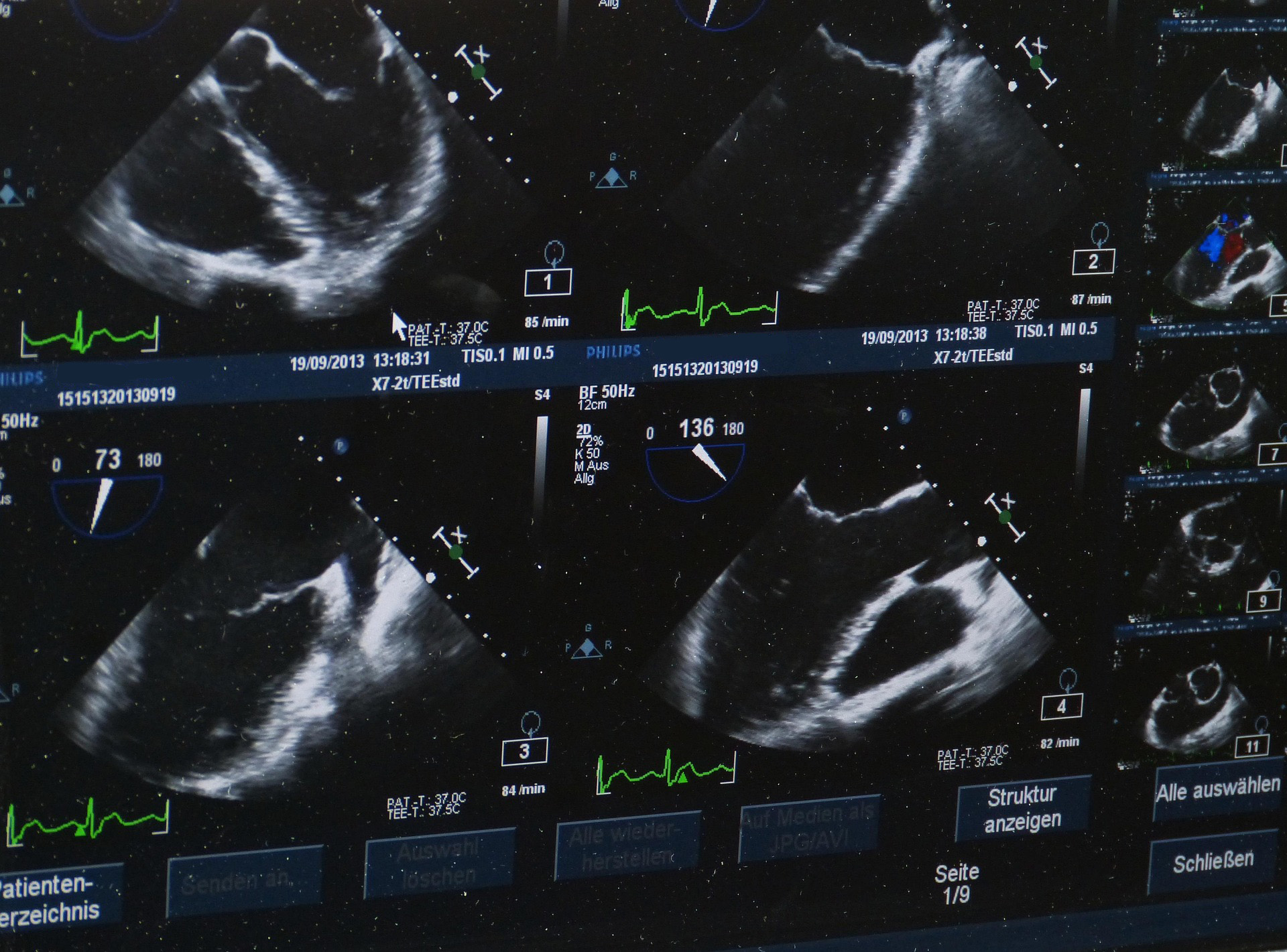 Thyroid ultrasound